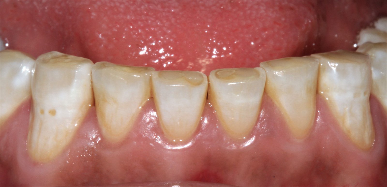Férulas de descarga dental